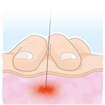 Dry Needling, smertebehandling