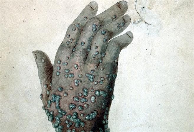 WALKING TOUR! To vax or not to vax: smallpox in early Boston