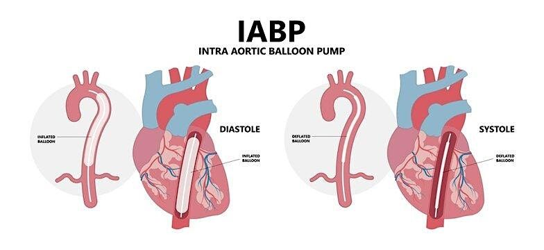 Intra Aortic Balloon Pump
