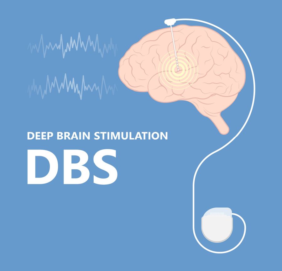Deep Brain Stimulation (DBS) and Parkinsons Disease | Move Up Health ...