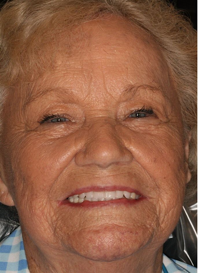 Removable Partial Dentures: Design and Fabrication (12 CE Credits)