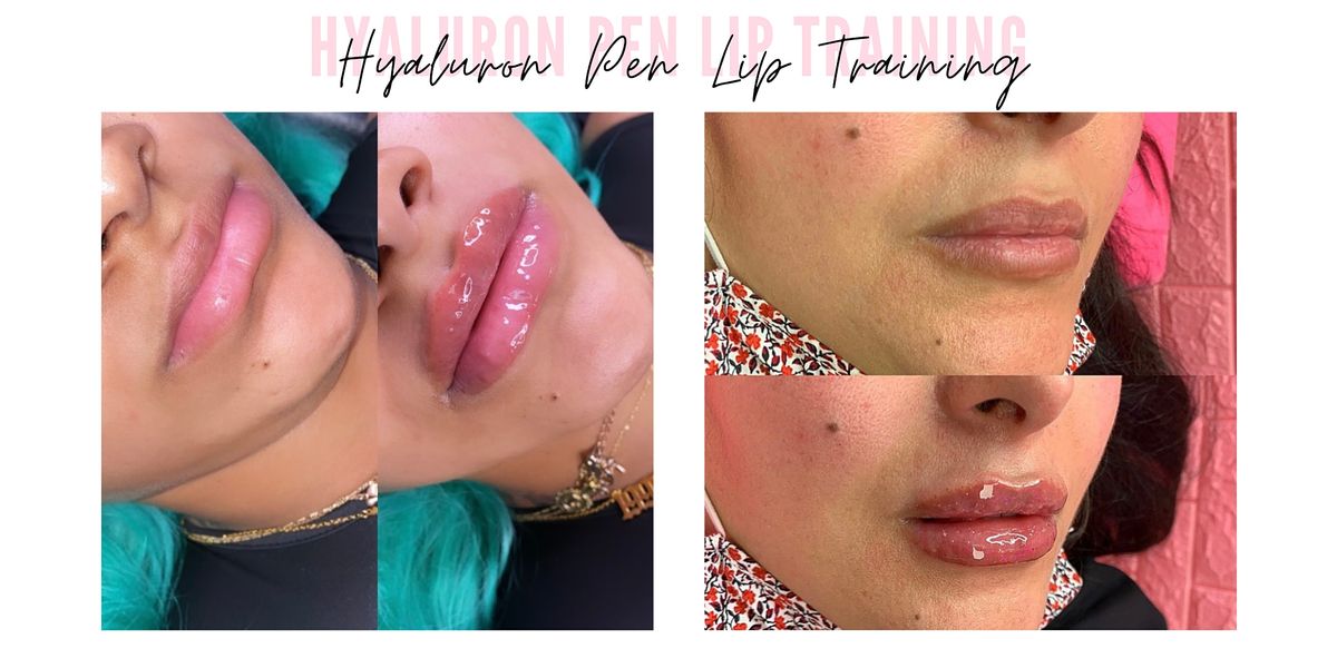 HYALURON PEN LIP TRAINING - NO NEEDLE LIP FILLER - HANDS ON | CHARLOTTE ...