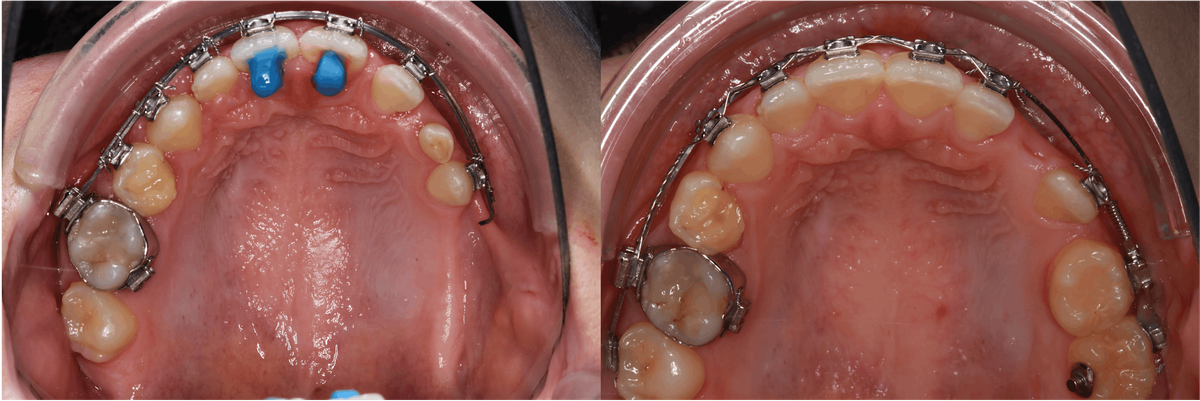 Charit\u00e9 Update - Autotransplantation