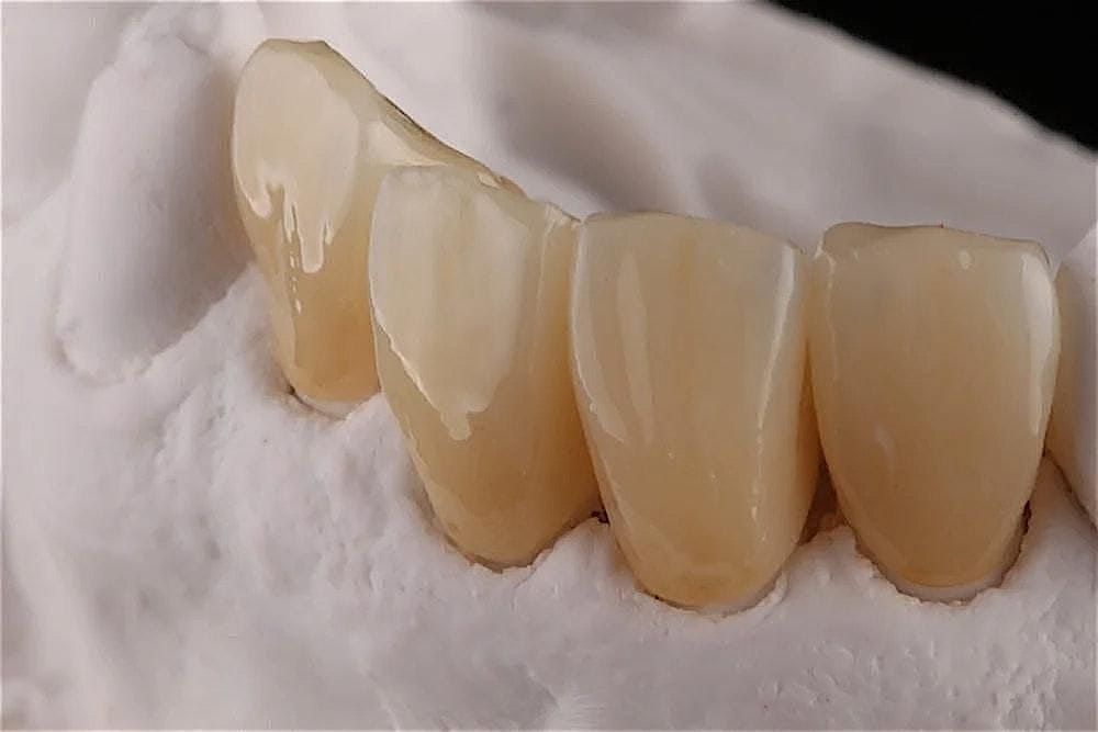 The Simplicity of Zirconia for Complex Restorative Cases