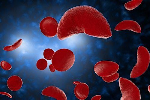 Beacon Community Impact Sickle Cell Conference 2025