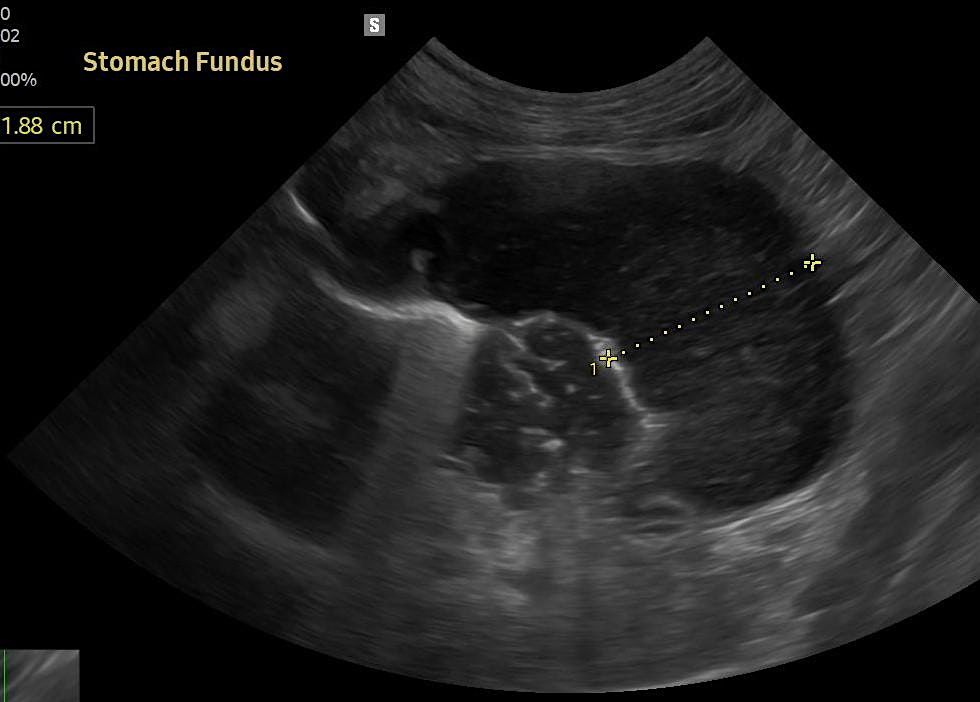 Ultrasound