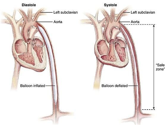 Intra Aortic Balloon Pump Training