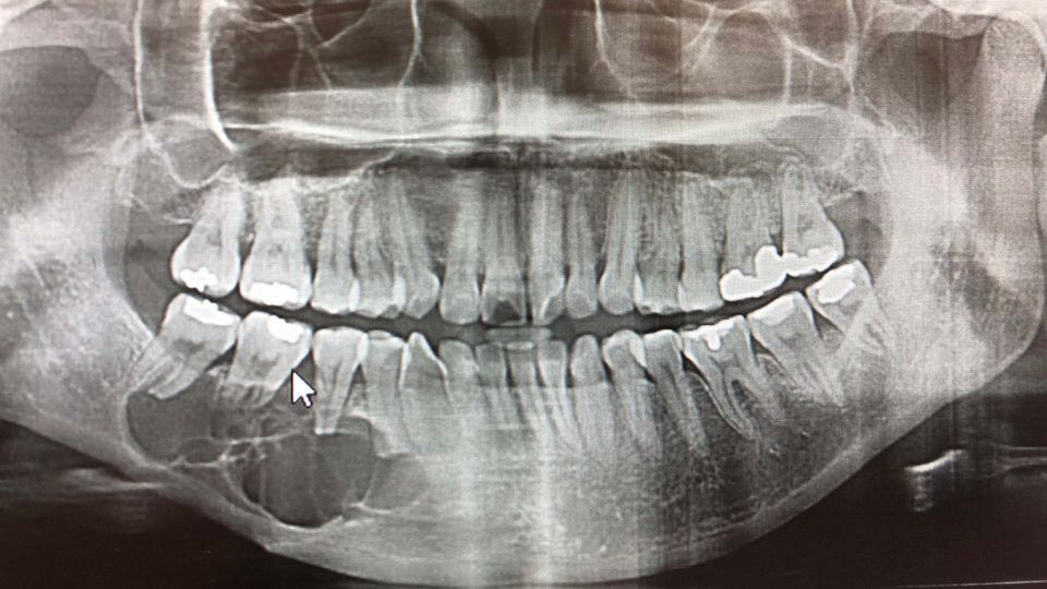 Glasgow oral surgery symposium - benign odontogenic tumours of the jaws